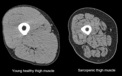 La sarcopenia ha sido reconocida como una enfermedad muscular, con consecuencias…