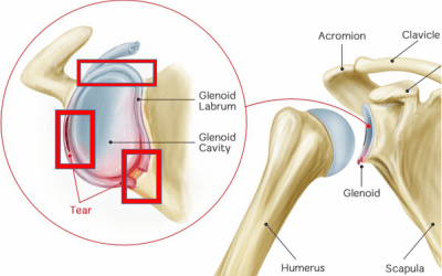 Función neuromuscular de la cintura escapular y la musculatura de las extremidades superiores en personas con antecedentes de reparación del labrum glenohumeral